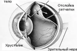 заболяване на ретината причини, симптоми, лечение