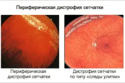 заболяване на ретината причини, симптоми, лечение