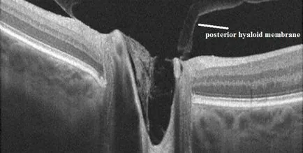 Обратно хиалоид мембрана (BMS) и излъчването си симптоми, диагностика и лечение клиники
