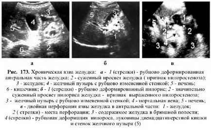 Stomac ulcer ultrasunete