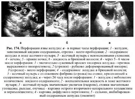 Stomac ulcer ultrasunete