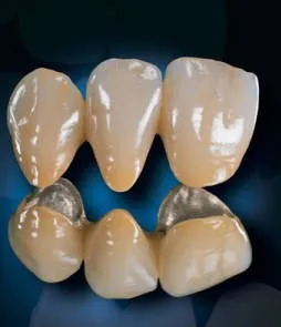 Ivoklyar протези в стоматологична клиника зъболекар