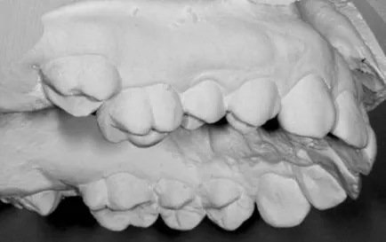 Dentoalveolar nyúlás okok, osztályozás, diagnózis és kezelés