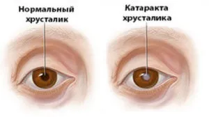 Simptomele astigmatismul, cauze si tratament cu fotografii