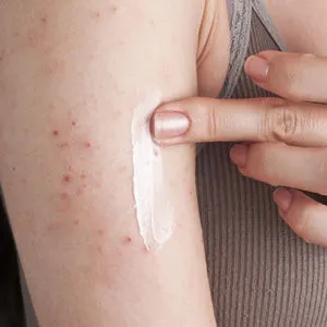 Алергични симптоми и лечение на кожата