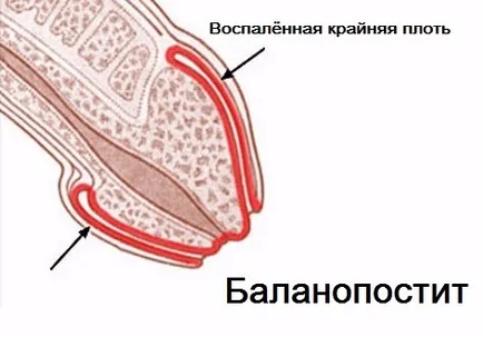 Balanoposthitis fotografie la bărbați tratați la domiciliu