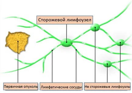 Sentinel биопсия на лимфен възел за кожата меланом в Израел