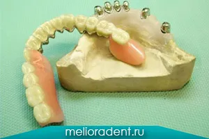 Kapcsos fogsor megfizethető fogászati