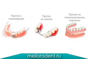 Kapcsos fogsor megfizethető fogászati