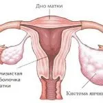 Кистата на яйчниците е опасно - последствия от заболяването, могат да се разтворят