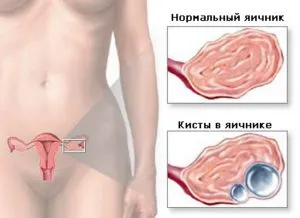 Кистата на яйчниците е опасно - последствия от заболяването, могат да се разтворят