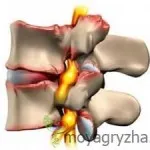 Diverticul a duodenului