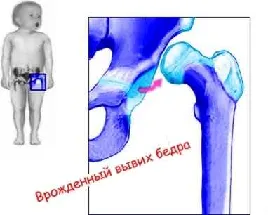 Csípőficam gyermekeknél és felnőtteknél