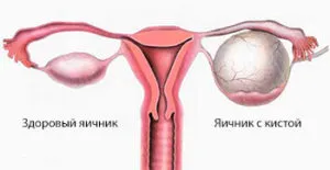 Доброкачествена класификация тумор на яйчниците и третиране