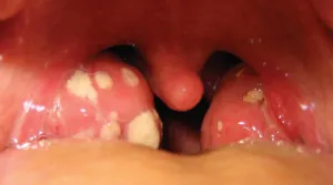 Tonsillitis tünetei és jellemzői a kezelés