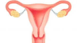 ablatia Foose de fibrom uterin cum se face, atunci când se administrează
