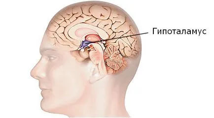 A hipotalamikus szindróma pubertás, mind a férfiak és a nők, a tünetek, a kezelés