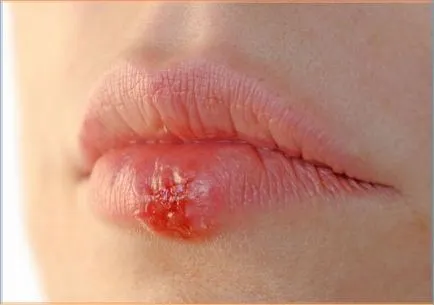 Cauzele Herpes alapteaza si tratament