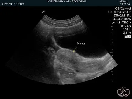 infantilism genital