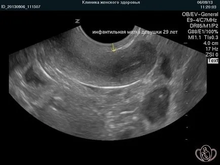 infantilism genital