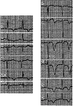 infarct miocardic și complicații clinice