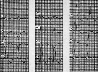 infarct miocardic și complicații clinice