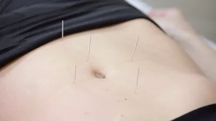 Acupunctura - Contraindicații și precauții