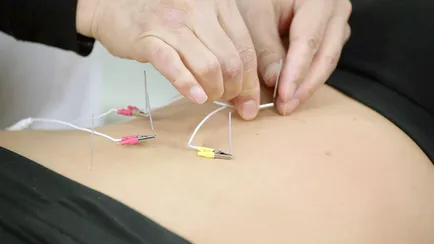 Acupunctura - Contraindicații și precauții