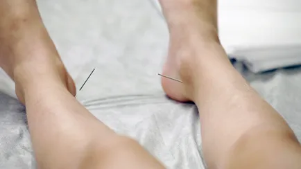 Acupunctura - Contraindicații și precauții