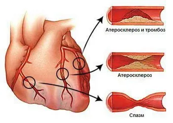 Simptomele și tratamentul Ischemia remedii populare ischemie