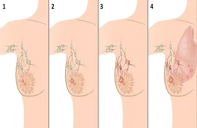 Колко бързо развитие на рак на гърдата