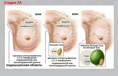 Колко бързо развитие на рак на гърдата