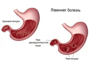 Как за лечение на язва на стомаха у дома при възрастни