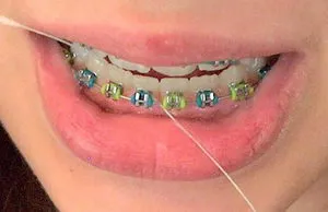 Как да използвате конец за зъби за почистване на скоби и около корекция ухапване тиранти