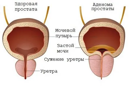 Как за лечение на аденом на простатата прополис