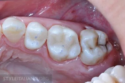 Hogyan lehet visszaállítani a fogak gyorsan lezárjuk modellezési technika