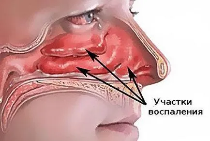 Orr-cseppek gyerekeknek protagol használati utasítást a sinus, vélemények