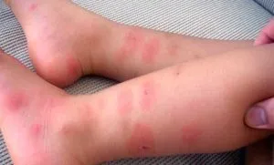 Urticaria la copii si simptome cauze, diagnostic și tratament