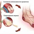 Лечението на диабет тип 2 чесън рецепти за диабетна чесън