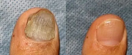 гъбички лечение на ноктите под формата на работа през 2017 г.