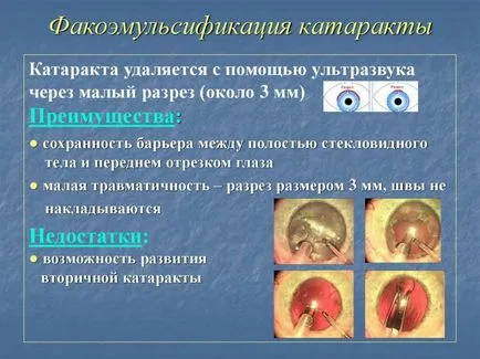 Лечение на вторична катаракта след смяна на обектива - причини и симптоми