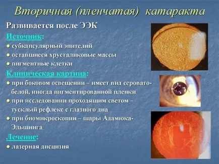 Másodlagos szürkehályog kezelésére csere után a lencse - okai és tünetei