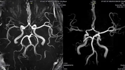 MRI на мозъчните съдове в Москва цени, ангиография на главата и артерии с и без kontastom