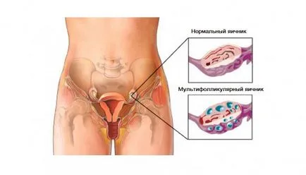 Multifollikulyarnye яйчници, че е как да се забременее и синдром на бременността multifollikulyarnyh