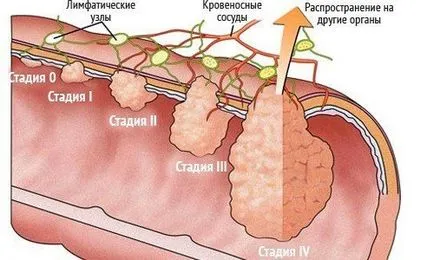 ЯМР черво, стомаха, с права, дебелото черво както