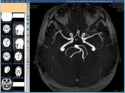 RMN a vaselor cerebrale prețurilor Moscova, angiografia a capului și a arterelor cu și fără kontastom