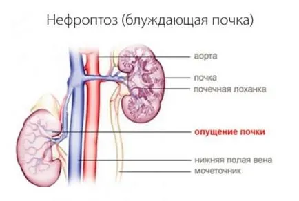 rinichi nephroptosis ce este, și gradul de tratament al bolii