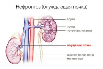 vese nephroptosis mi ez, és mennyire a betegség kezelésében