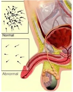 Oligospermia kezelési lépést és