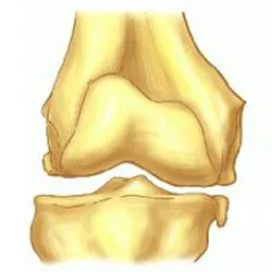 Osteofite bolii articulare - cauze, simptome și tratament